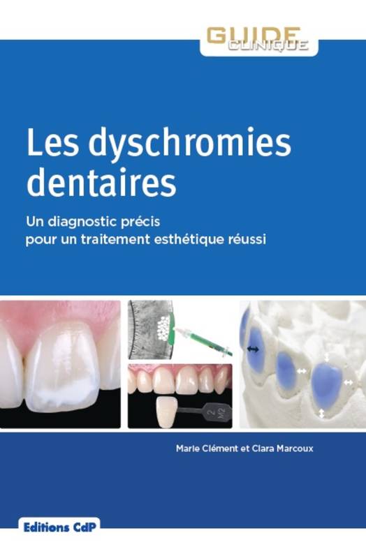 Les dyschromies dentaires, Un diagnostic précis pour un traitement esthétique réussi