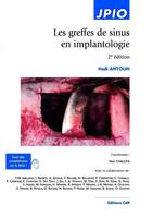 Les greffes de sinus en implantologie, 2E EDITION